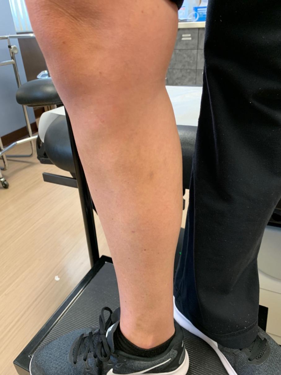 Varicose Veins