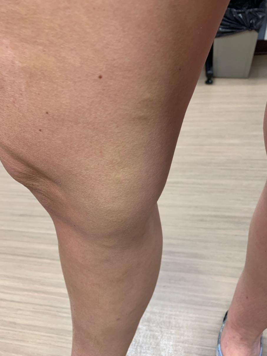 Varicose Veins