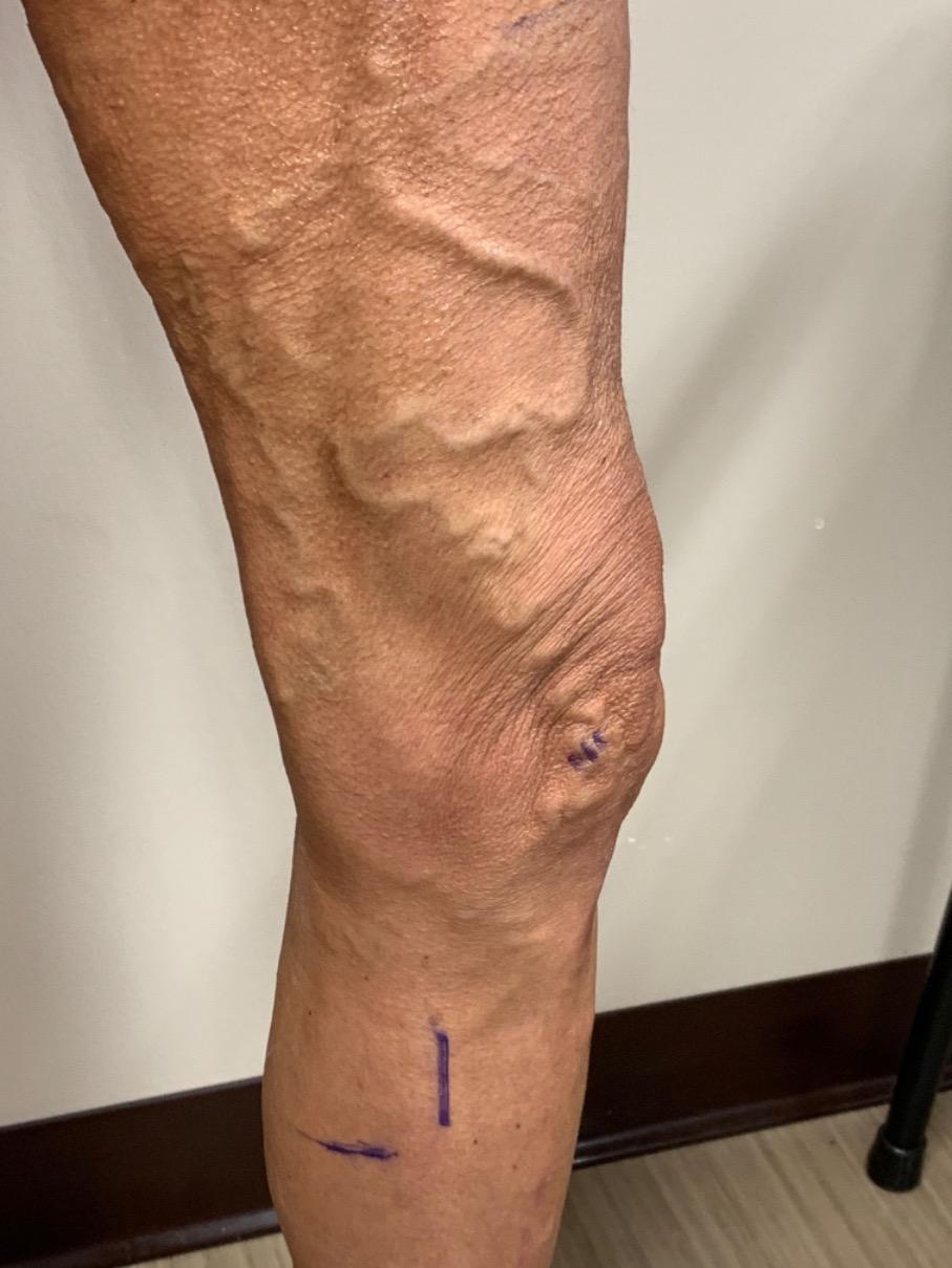 Varicose Veins