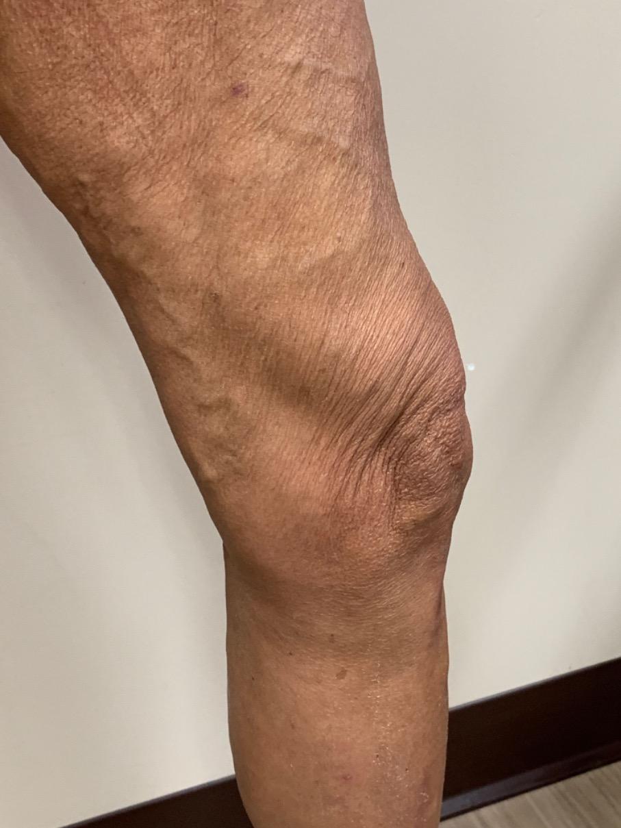 Varicose Veins