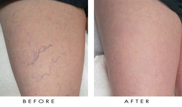 Before and After Schlerotherapy - thigh