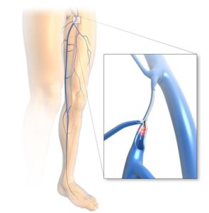 Laser Vein Treatment (EVLA) – The Vein and Laser Centre