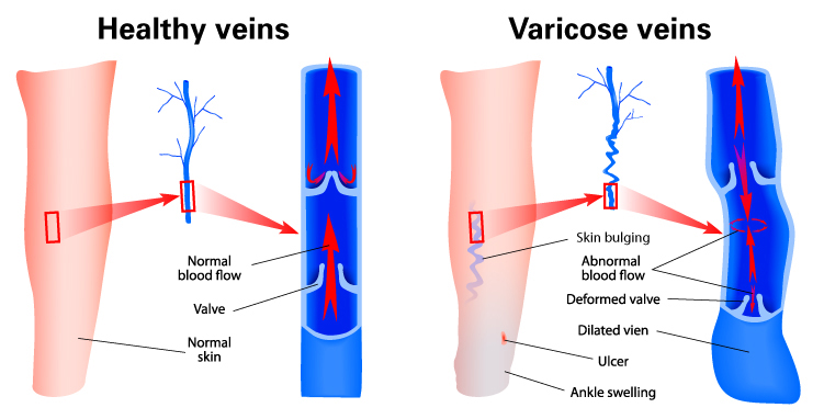 Healthy Veins vs. Varicose Veins