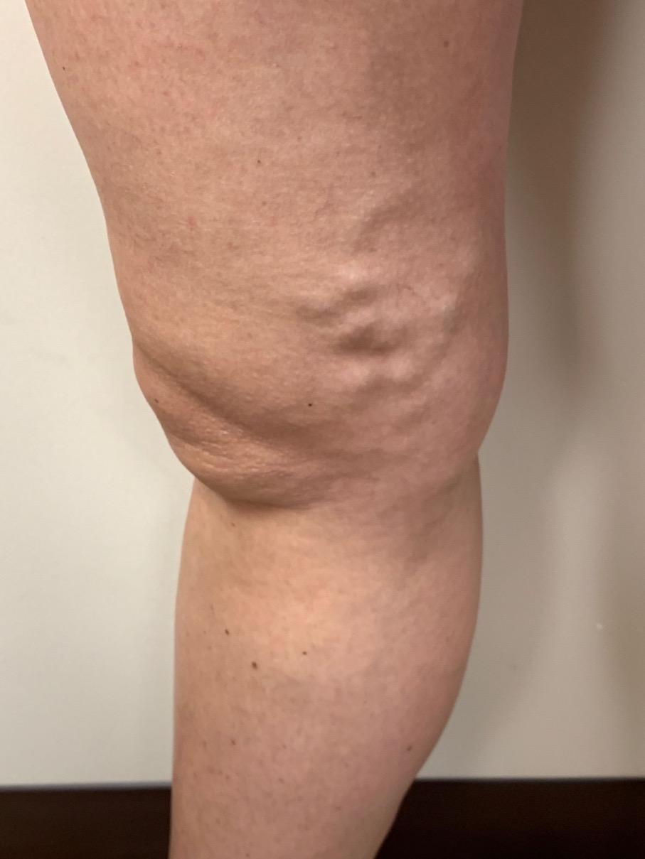 Varicose Veins