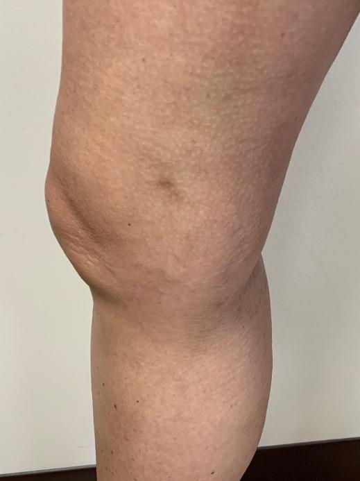 Varicose Veins