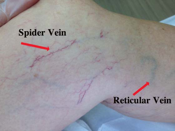 spider and reticular veins