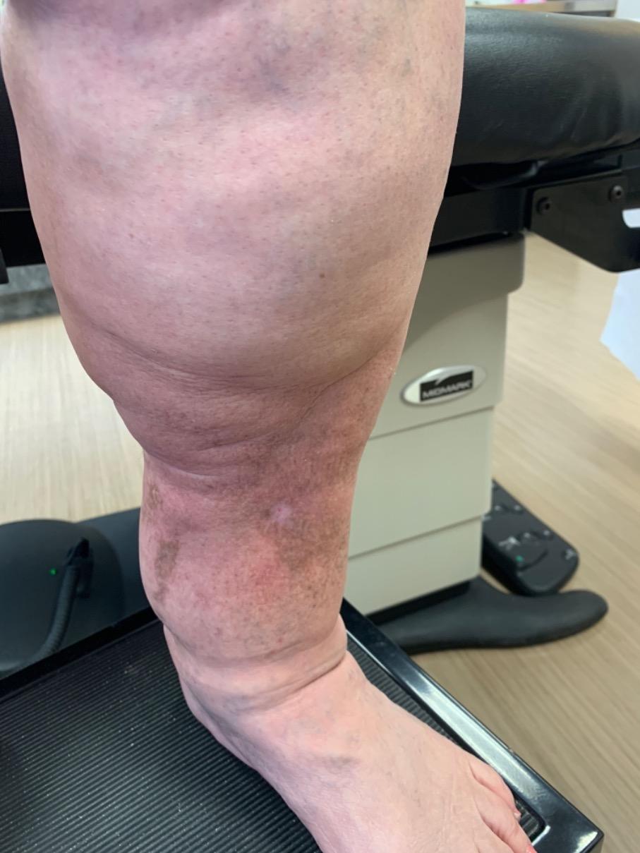 Varicose Veins