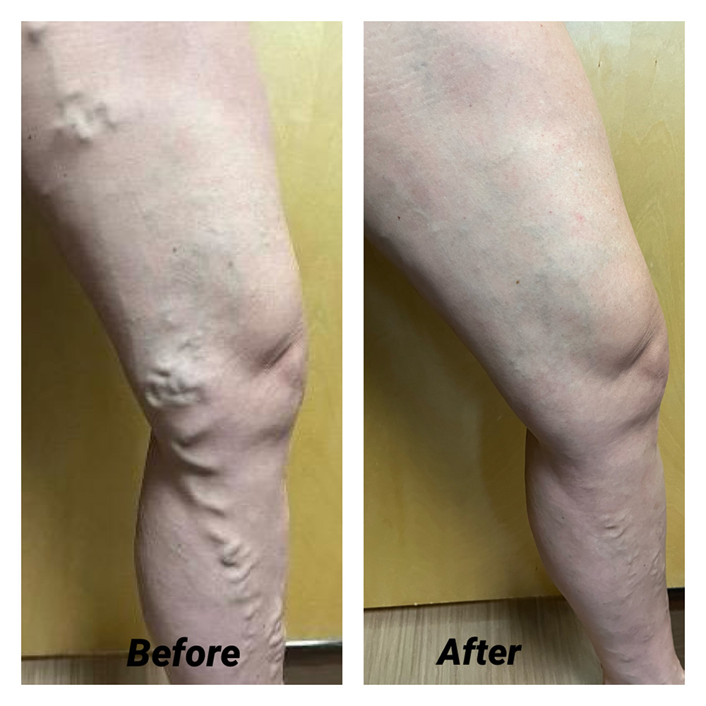 1 Before and After Vein and Laser