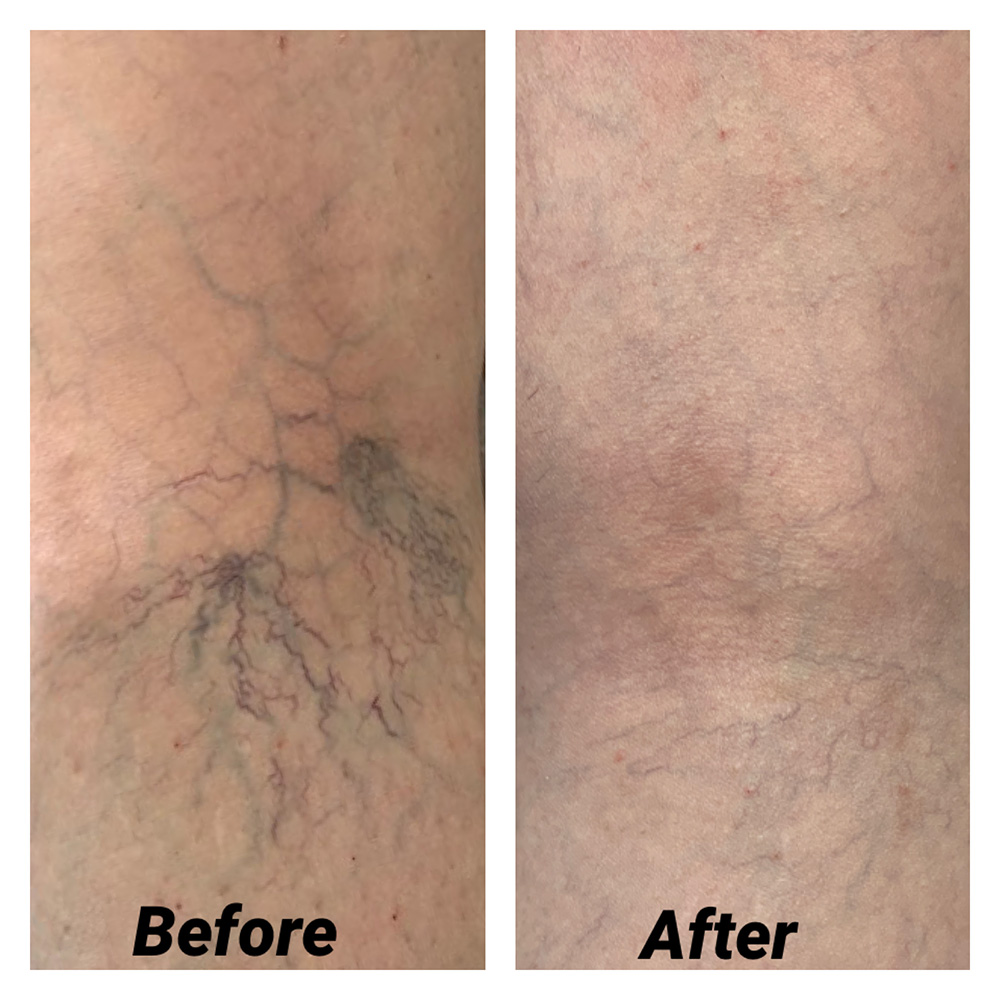 2 Before and After Vein and Laser