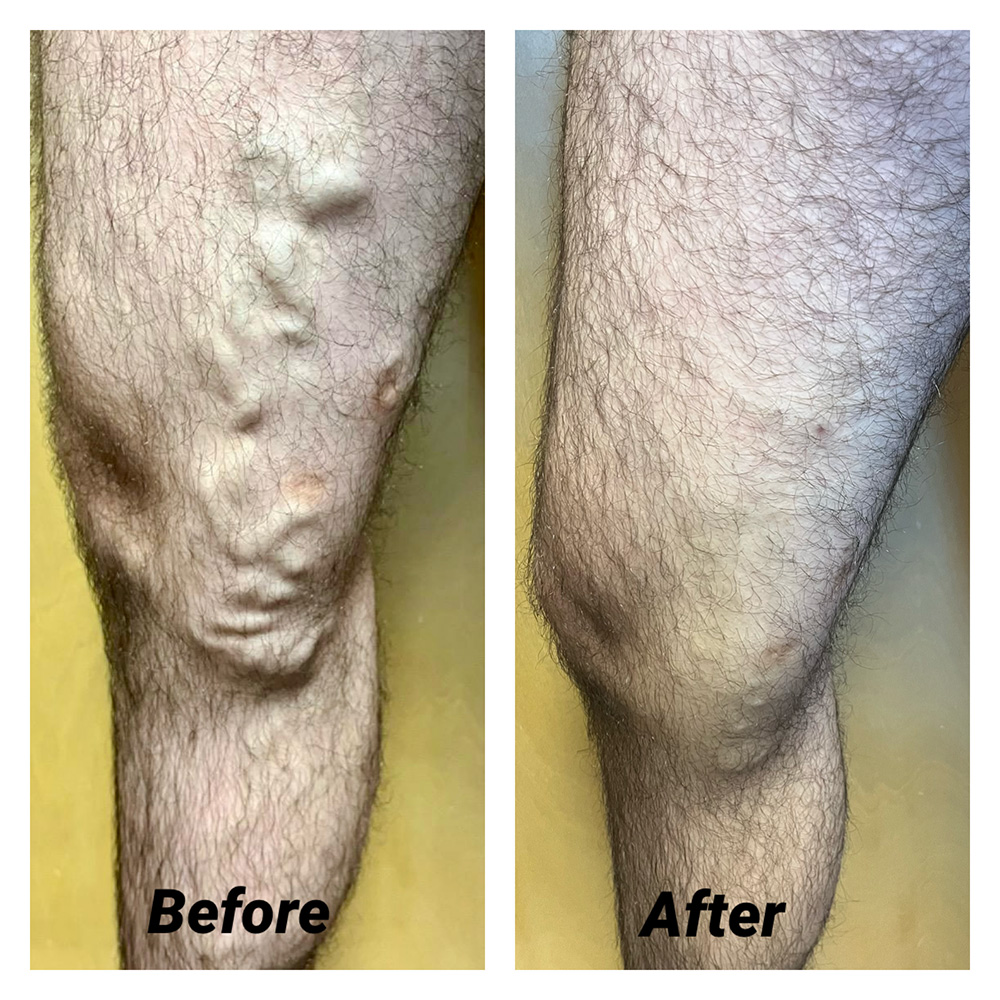 3 Before and After Vein and Laser